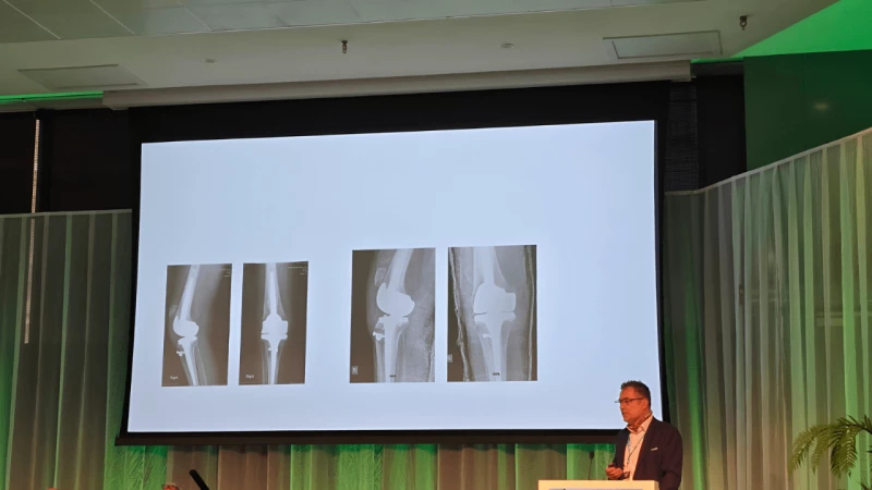 Проф. Пламен Кинов постави България на картата на световната колянна хирургия